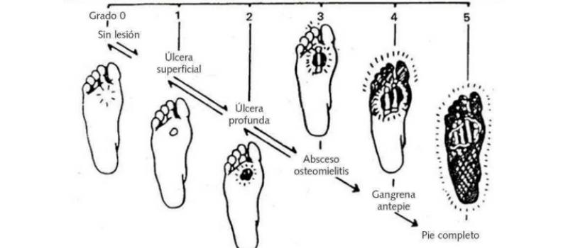 necrobiosis diabética  pie diabético