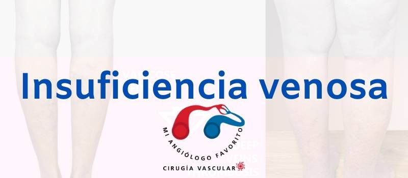información sobre insuficiencia venosa