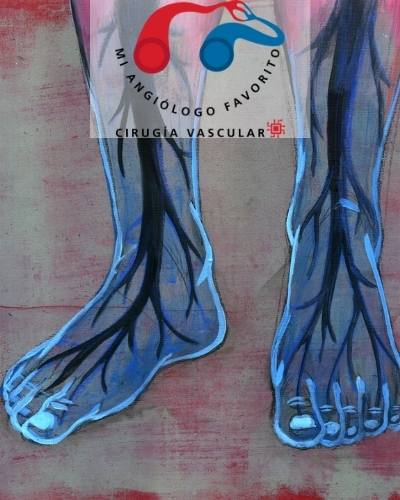 necrobiosis diabetica