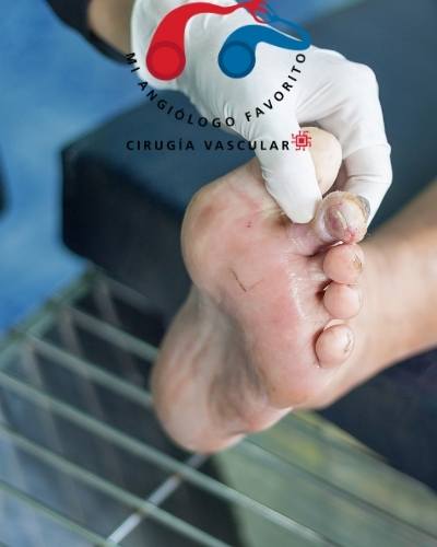tratamiento de pie diabetico