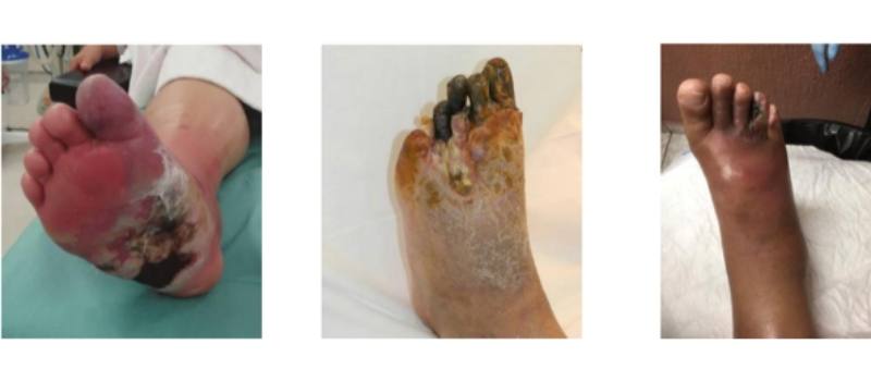 necrobiosis diabética grado 4 pie diabético