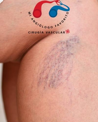 que es la insuficiencia venosa crónica