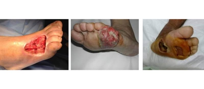 necrobiosis diabética grado 2 pie diabético
