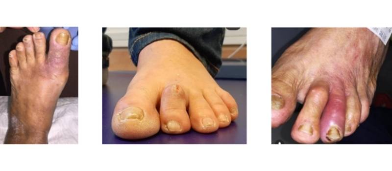 necrobiosis diabética grado 1 pie diabético