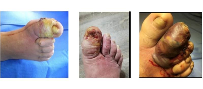 necrobiosis diabética grado 3 pie diabético