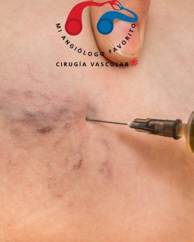 cual es tratamiento insuficiencia venosa crónica 
