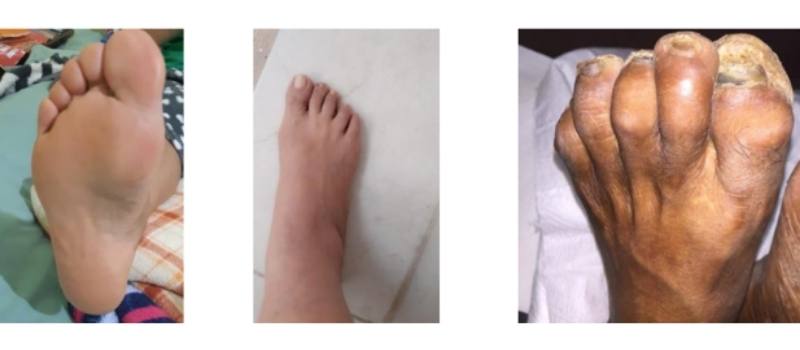 necrobiosis diabética grado 0 pie diabético