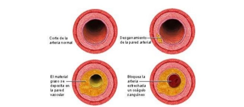 lesion pared arterial pie diabetico