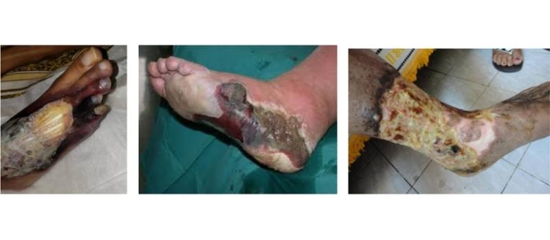 necrobiosis diabética grado 5 pie diabético