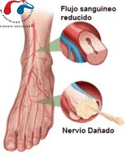 neuropatia diabética y píe diabético